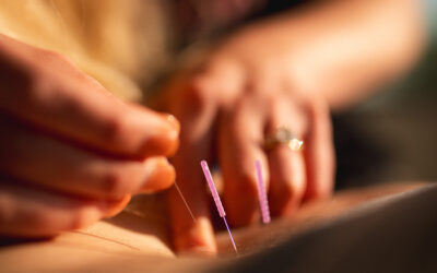 Dry Needling: A Game Changer for Healing, Strength, and Pelvic Health