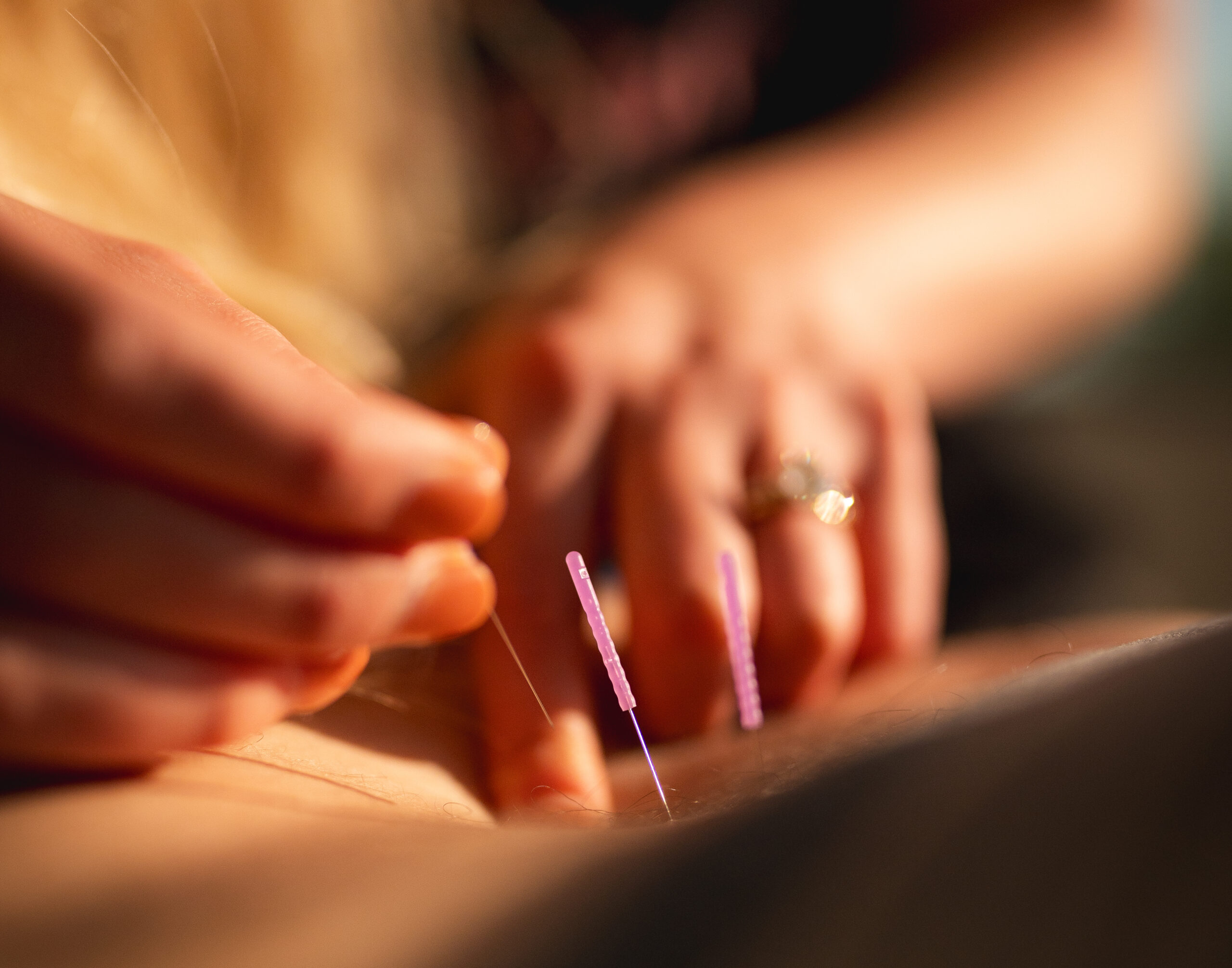 dry needling utah millcreek