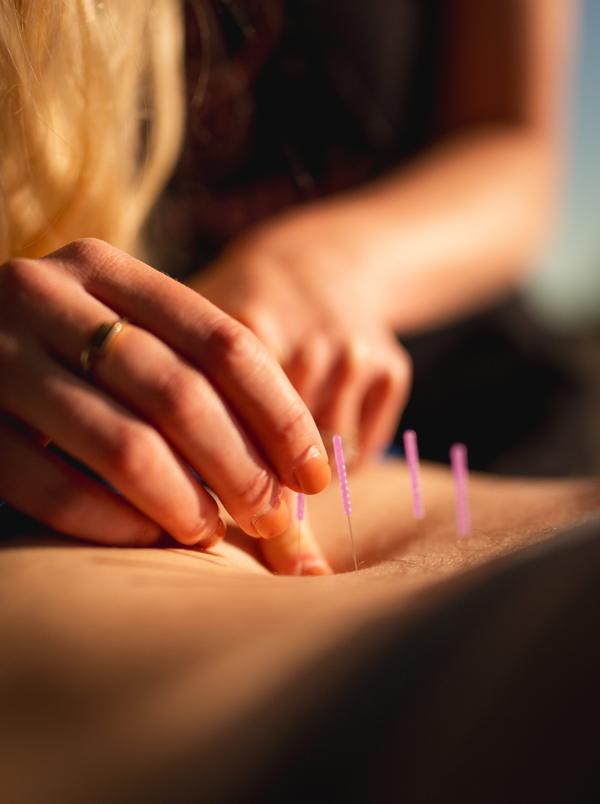 Dry needling millcreek